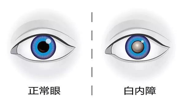 眼睛退化不用怕！白內障手術“辭舊迎新”，讓老年人想怎么看就怎么看！