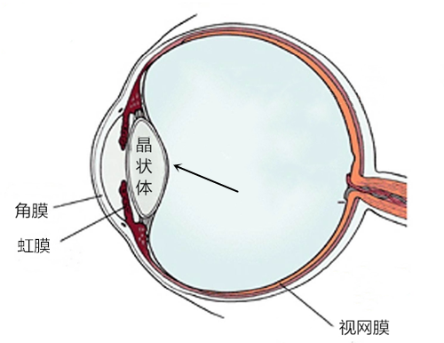 不要怪身體沒“警告”你，白內障初期有這五大癥狀