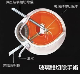 劇烈運動還會導致視網膜脫落？高度近視人群要小心了