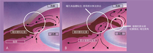 會(huì)導(dǎo)致嚴(yán)重受損的三大致盲性眼病你都知道嗎？