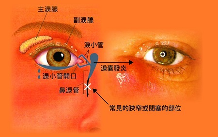 溢淚和流淚不一樣，需引起重視