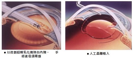 白內障手術