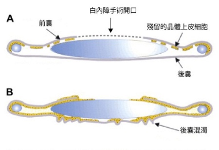 后囊混濁