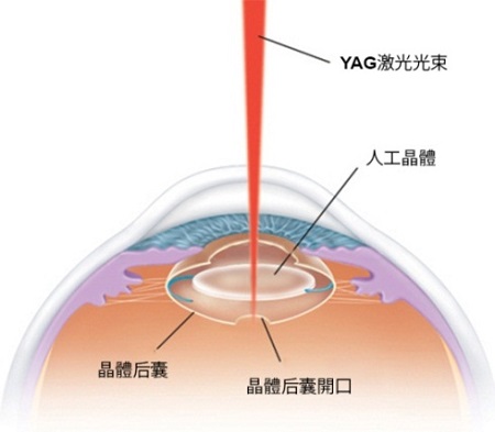 YAG激光治療