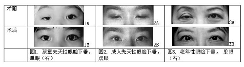上瞼下垂怎么辦