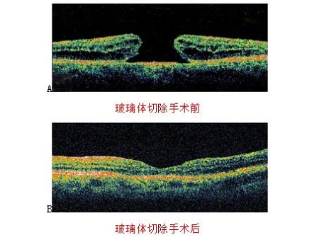 黃斑裂孔治療