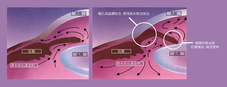 急性青光眼并發(fā)癥