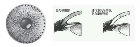 青光眼治療
