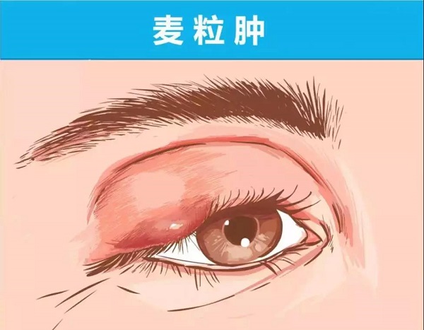 眼睛腫了，到底應該熱敷還是冷敷？這次終于解釋清楚了！