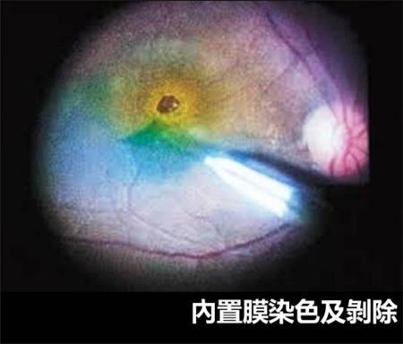 黃斑前膜剝除
