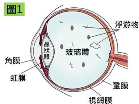 飛蚊到底是什么