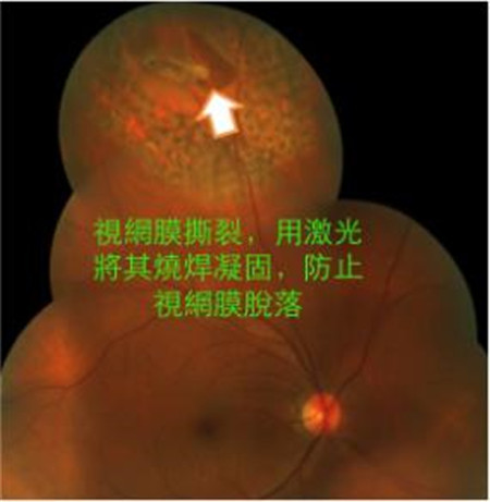 惡性飛蚊需對癥治療