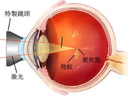 YAG激光玻璃體溶解術