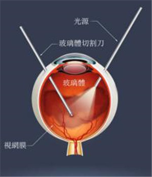 玻璃體切除術