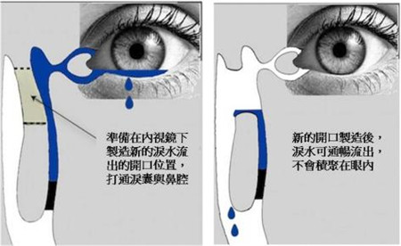 淚囊鼻腔吻合手術