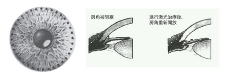激光虹膜邊緣成形手術(shù)