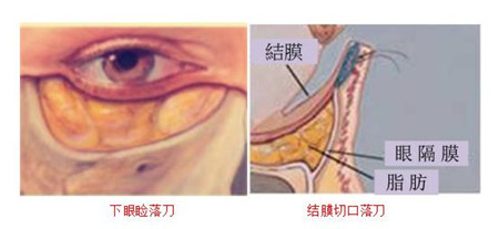 眼袋手術(shù)