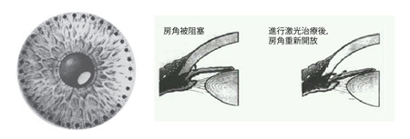 激光虹膜邊緣成形手術