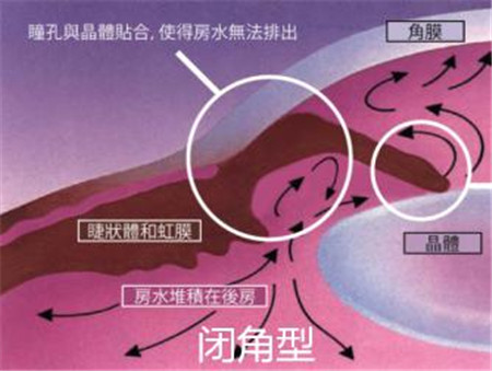 閉角型青光眼