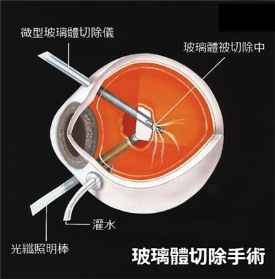 玻璃體注射