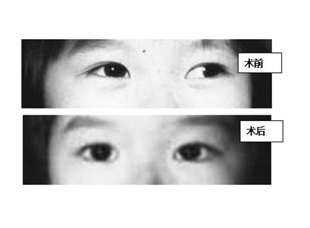 斜視手術治療