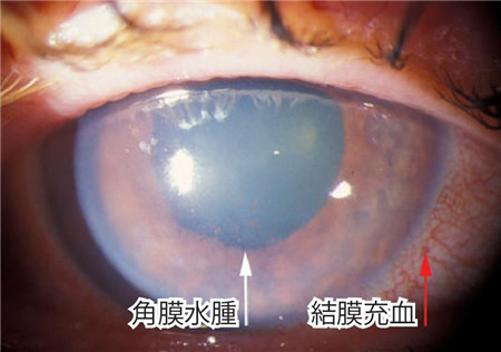 青光眼發作角膜水腫