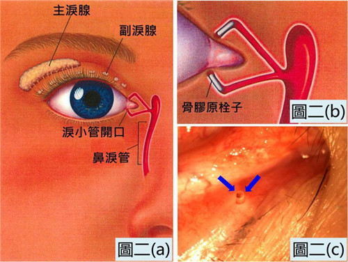 淚小點封閉手術治療干眼癥