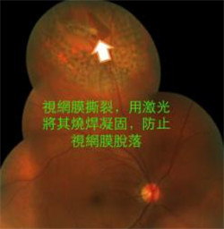 激光治療視網(wǎng)膜撕裂