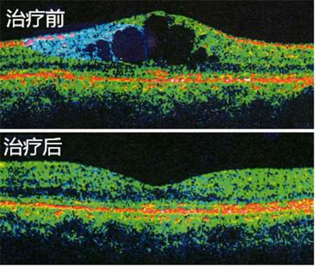 黃斑水腫治療