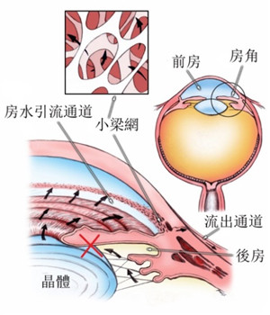 白內障和青光眼的關系