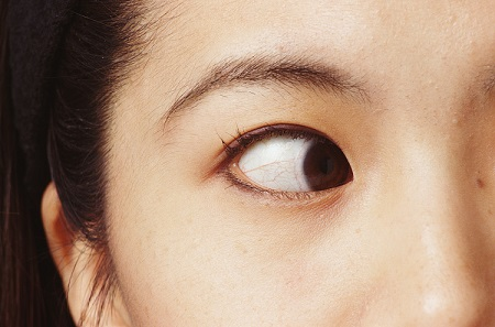 斗雞眼怎么辦