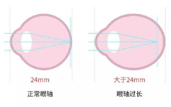 近視就不會患上老花眼?近視的你別等老花找上門才了解真相!