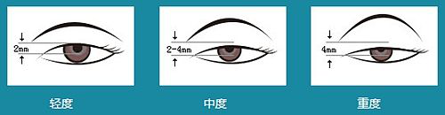 沒睡醒?看起來沒精神?眼瞼下垂可不僅僅是皮膚松弛那么簡(jiǎn)單!