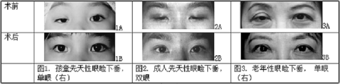 沒睡醒?看起來沒精神?眼瞼下垂可不僅僅是皮膚松弛那么簡(jiǎn)單!