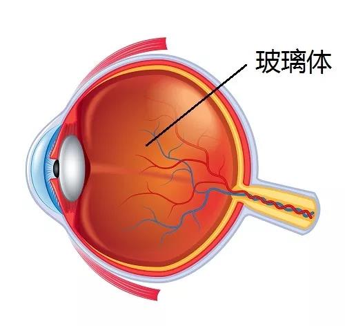 高度近視為什么會引起視網(wǎng)膜脫落呢？