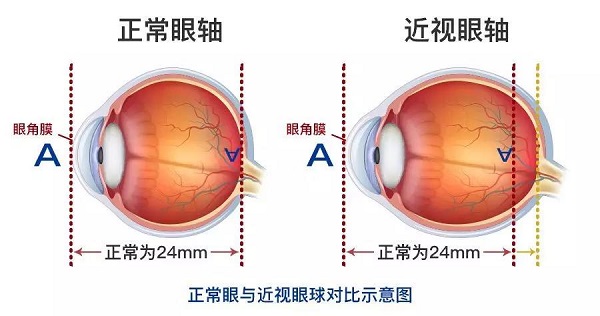 高度近視為什么會引起視網(wǎng)膜脫落呢？