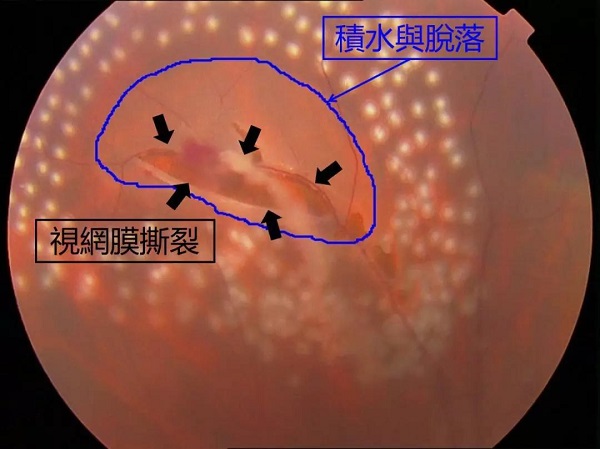 你真的了解視網膜嗎？如果視網膜脫落可以這樣治療！