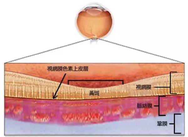 你真的了解視網膜嗎？如果視網膜脫落可以這樣治療！