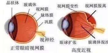 你真的了解視網膜嗎？如果視網膜脫落可以這樣治療！