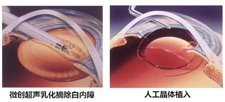 白內障手術