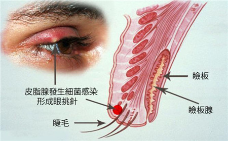 麥粒腫發生原因