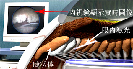 內(nèi)視鏡下睫狀體光凝固術(shù)
