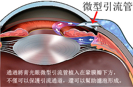 青光眼引流管手術(shù)