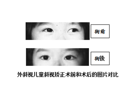 斜視矯正手術