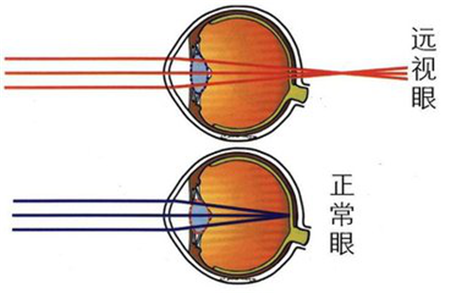 遠視形成的原因