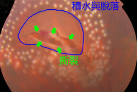 視網膜撕裂的原因