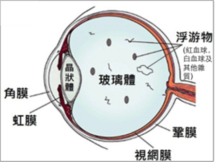 飛蚊癥是如何形成的