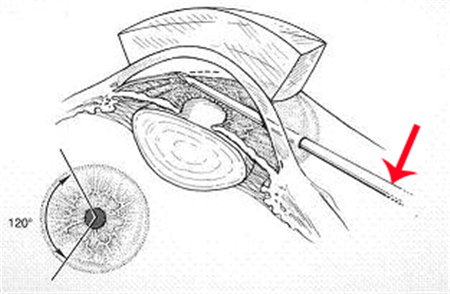 青光眼手術(shù)治療