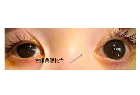 兒童青光眼癥狀