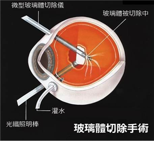 玻璃體切除手術